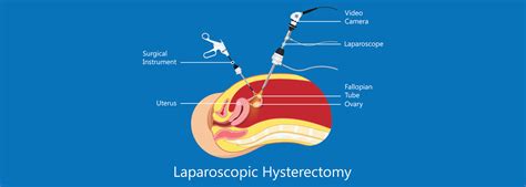 A Complex Case of laparoscopic hysterectomy - RBH 