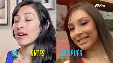 La Rinoplastía Y Sus Consideraciones En El Caso De Hombres Y Mujeres Atv