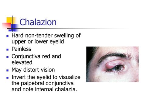 Ppt The Differential Diagnosis Of The Red Eye Powerpoint Presentation