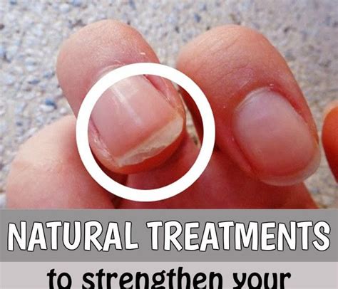 Natural Treatments To Strengthen Your Nails Health And Fitnes