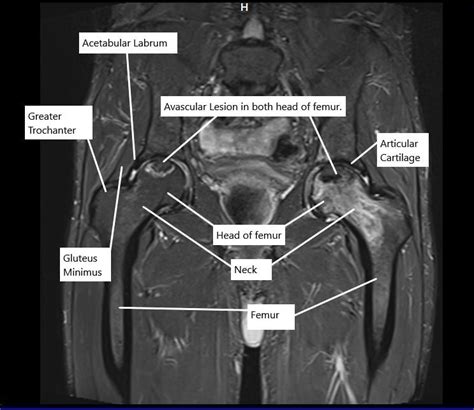 Bone Graft Of Treatment Of Avascular Necrosis Complete Orthopedics