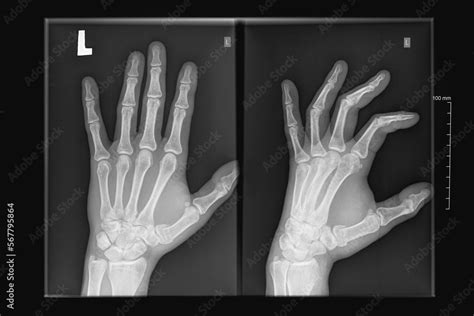 X-ray image of human hands, arm fracture Stock Photo | Adobe Stock