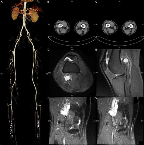 Frontiers Compression Syndromes Of The Popliteal Artery Due To