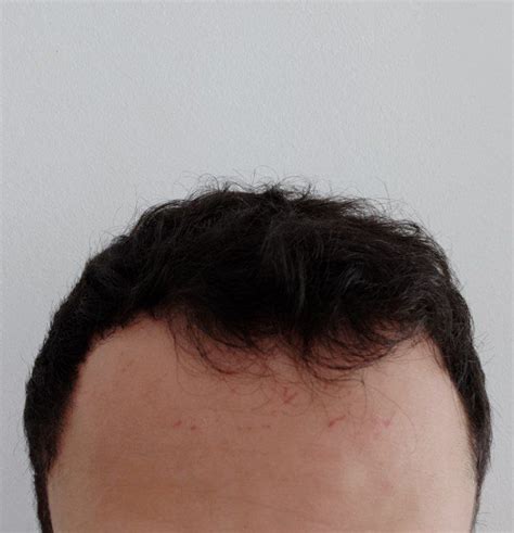 Minoxidil Results Before After Amazing Pictures