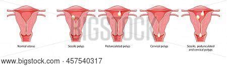 Set Polyps Uterus Vector Photo Free Trial Bigstock