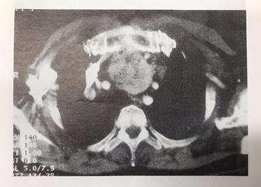 Neck-mediastinum CT scan revealing the mass located in the anterior... | Download Scientific Diagram