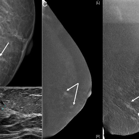 42 Year Woman With Palpable Left Breast Lump A Standard Mammogram