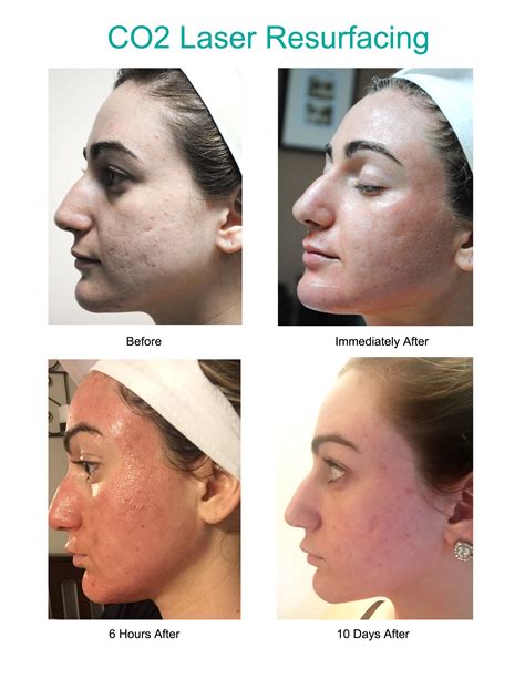 Results From Co2 Laser Resurfacing See What To Expect Immediately After 6 Hours After And 10