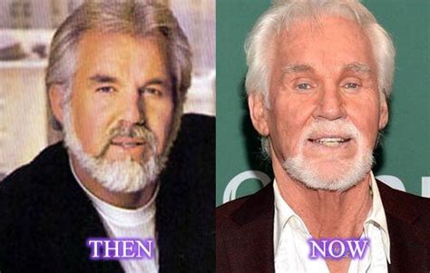 Kenny Rogers Plastic Surgery