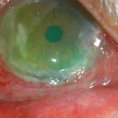 Peripheral ulcerative keratitis in a rheumatoid arthritis patient ...