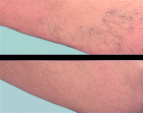 Treatment of Venous Disorders | Varicose Veins | Spider Veins - [The Elite Laser Vein Center]