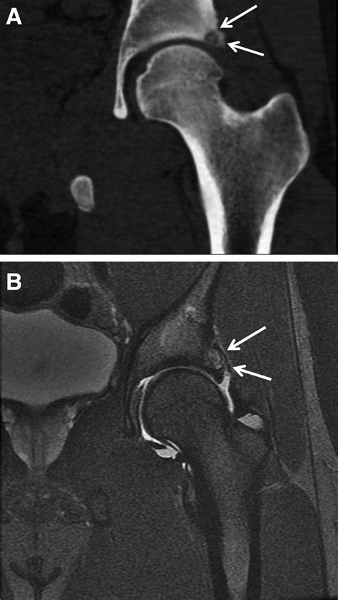 Hip Arthroscopy For Removal Of An Acetabular Rimbased Osteoid Osteoma