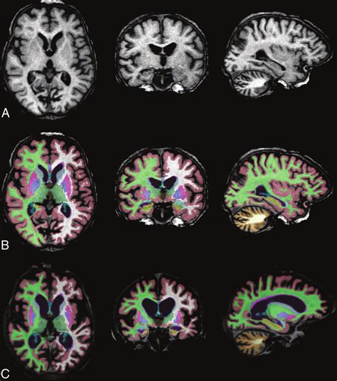 Progressive Brain Atrophy In Cln2 Disease Baseline 3d T1 Weighted