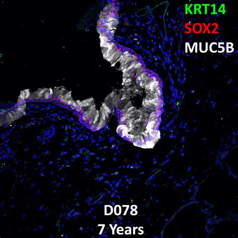 Year Old Human Lung With Asthma Immunofluorescence And Confocal