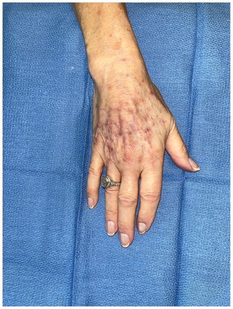 Phlegmasia Cerulea Dolens Of The Upper Extremity Treated With