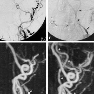 A And B DSA Images Of The Left Common Carotid Artery Demonstrate An