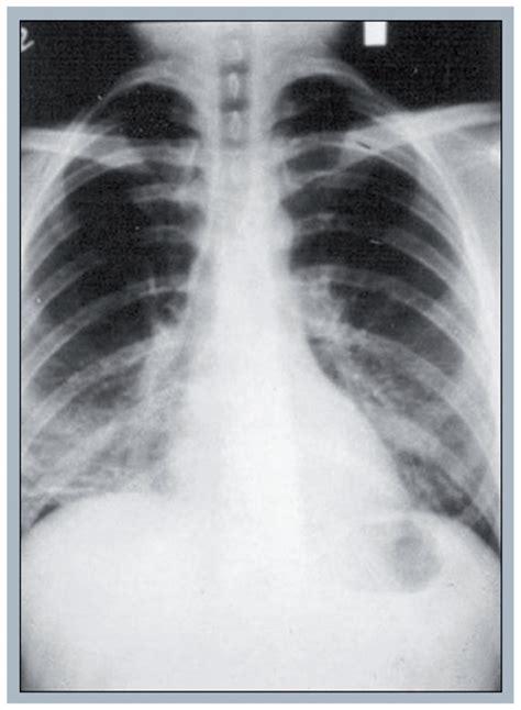 Chest Radiograph Of Pneumocystis Pneumonia A 23 Year Old Male With Download Scientific Diagram