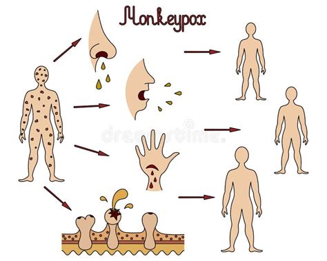 The Mechanism of Transmission of Monkeypox. Diagram of Human-to-human ...