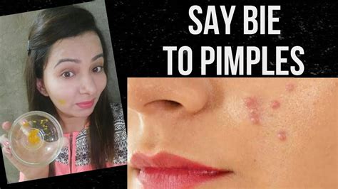 How To Remove Acne Permanentlyhow To Remove Pimples Overnightacne Treatment100effective