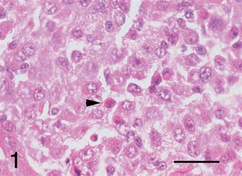 Immunohistochemical And Histopathologic Features Of 14 Malignant