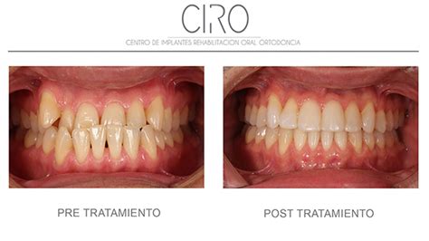 Maloclusión Dental Qué Es Y Cómo Solucionarlo Clínica Ciro