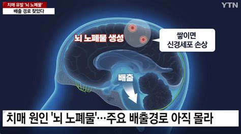 국내에서 세계최초로 치매 유발 뇌 노폐물 배출 경로 찾았다 유머이슈 꾸르