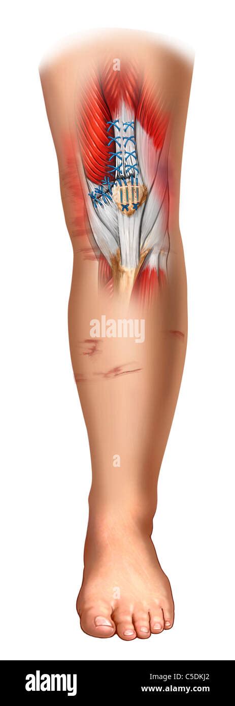 Medial retinaculum and suprapatellar tendon repair Stock Photo - Alamy