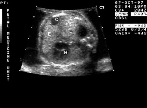 Figure 1 From Prenatal Sonographic Features Of Congenital Lobar