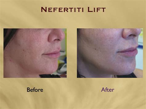 Aesthetics Hawaii Nefertiti Lift And Neck Wrinkle Smoothing With