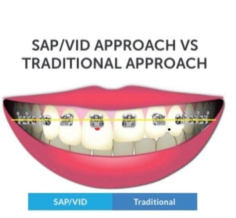 Smile Arc Protection Vs Traditional Brackets