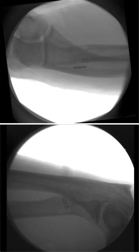 Anteroposterior And Lateral Intraoperative Fluoroscopic Image Depicting