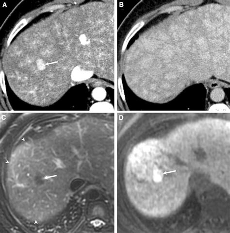 Congestive Hepatopathy Springerlink