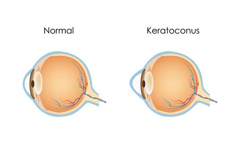 Keratoconus A Guide To Symptoms Causes And Care World Eye Care