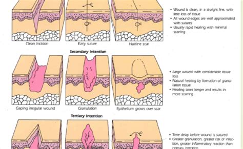 Exam 2 Stages Of Wound Healing And Skin Principles Flashcards Quizlet