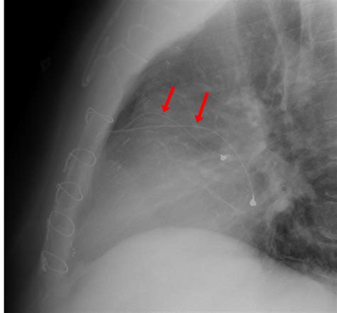 Epicardial pacing wires - Questions and Answers in MRI