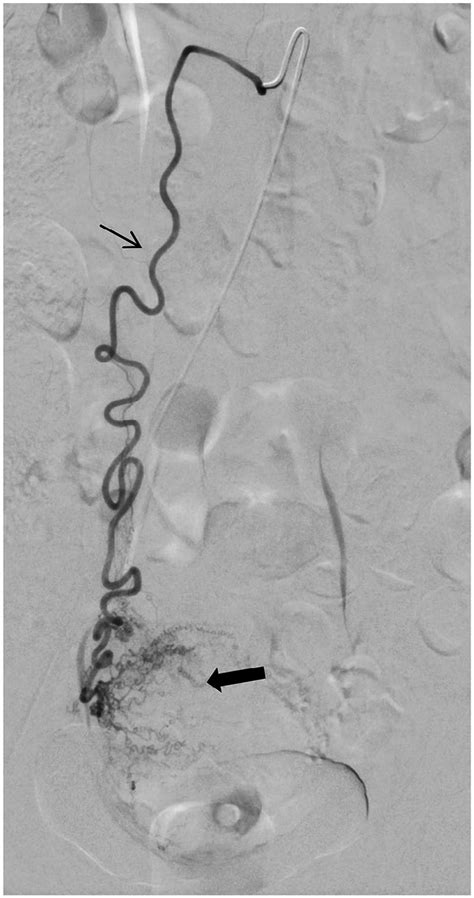 Digital Subtraction Angiography Performed With The Catheter In The