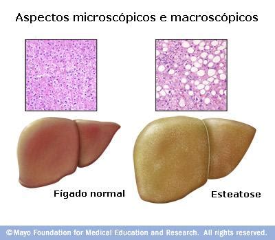 Esteatohepatite Não Alcoólica - vsvnutri: Esteatose hepática não alcóolica (NAFLD)