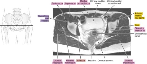 MRI of the female pelvis | Radiology Key