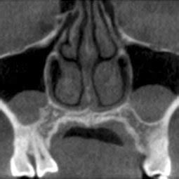 CBCT image of a patient with mucous retention cysts diagnosed ...