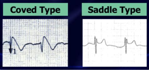 BRUGADA SYNDROME – ECG Weekly