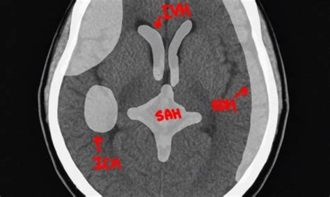 경막외출혈(EDH)란? 의학용어, 증상, CT, 간호, 치료, 수술, 후유증, burrhole, craniotomy, 개두술 ...