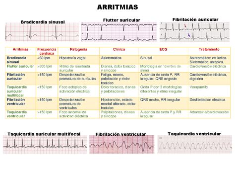 Infografía de Arritmias Cruz Martínez Luis Eduardo ARRITMIAS