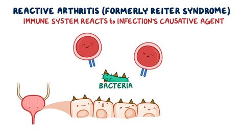 Reiter Syndrome Year Of The Zebra Video Anatomy Osmosis