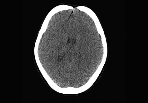 Cerebral computed tomography: note the open anterior fontanelle ...