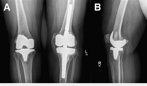 One Year Postoperative Bilateral Anteroposterior A And Right Lateral Download Scientific