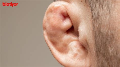 Cauliflower Ear Penyebab Pengobatan Dan Cara Mencegah Biotifor