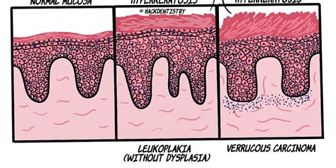 Common histopathology terms - Hyperkeratosis