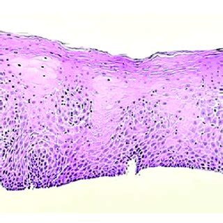 Proximal esophagus biopsy shows squamous mucosa with mild chronic ...