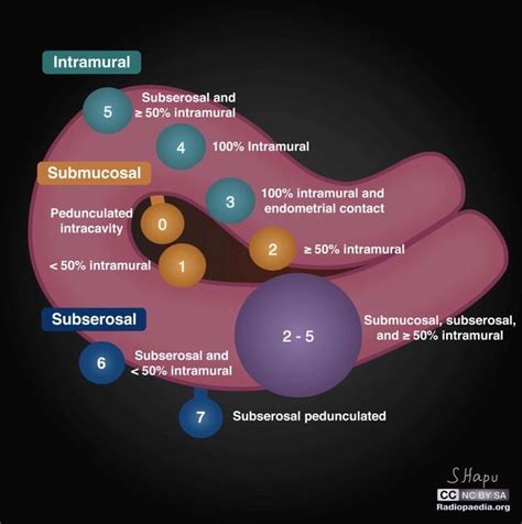 FIGO Classification System For Uterine Leiomyoma Radiology Reference