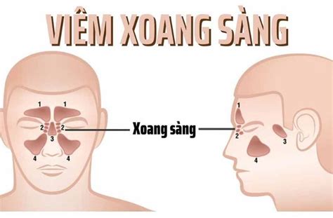 Viêm xoang sàng là gì nguyên nhân triệu chứng và cách điều trị